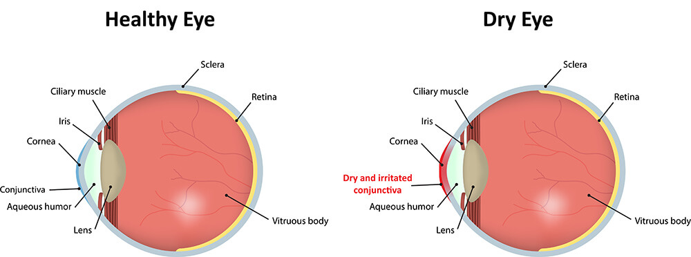 Chart Showing How Dry Eye Affects an Eye