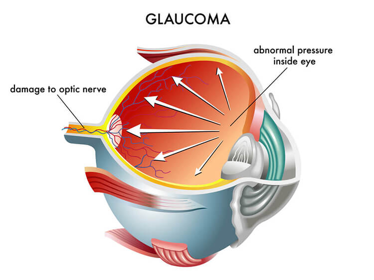 Illustration of an Eye With Glaucoma