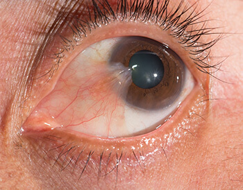 Pterygium in an Eye